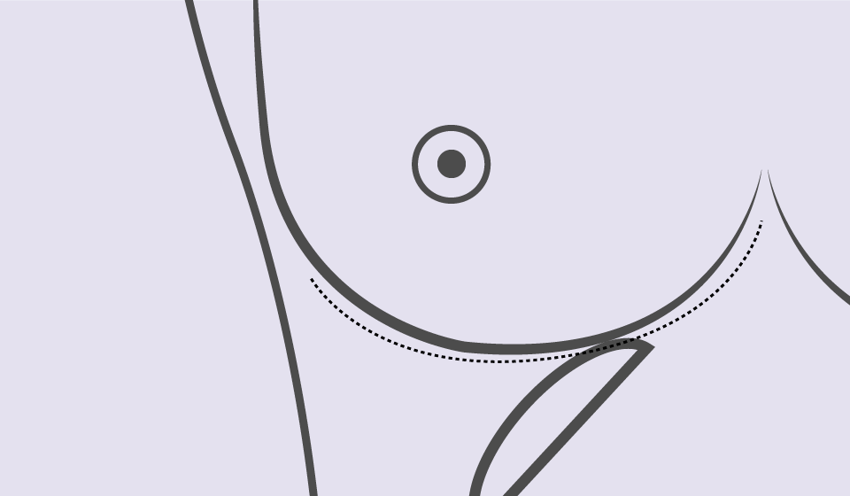 Mastectomía Radical Modificada