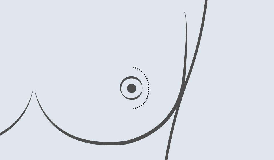 Resección de Conductos Terminales