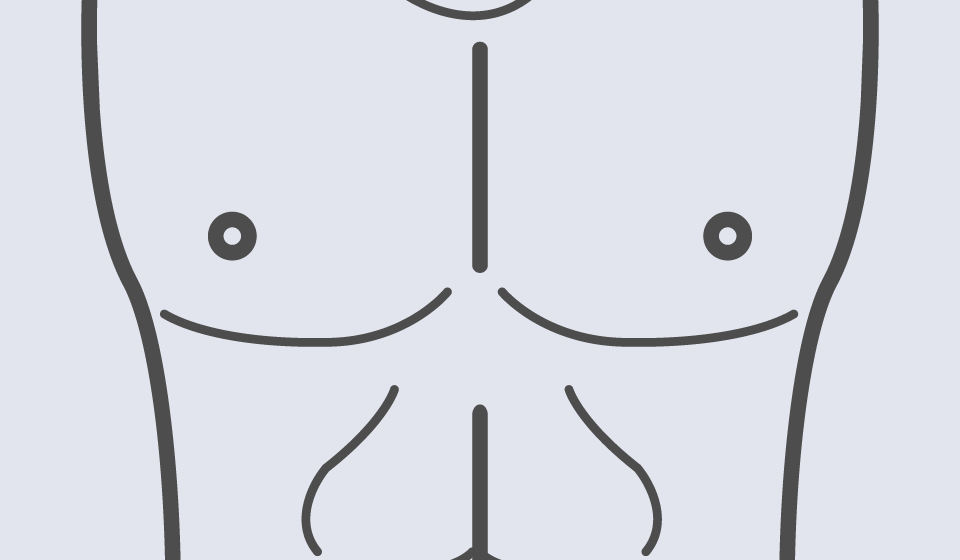 Mastectomía por Ginecomastia Masculina