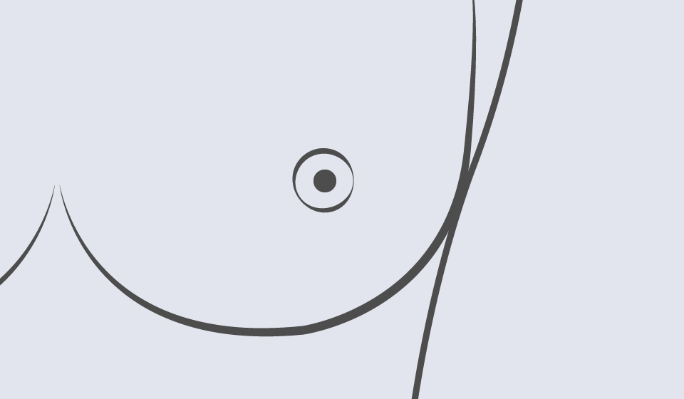 Reconstrucción Mamaria