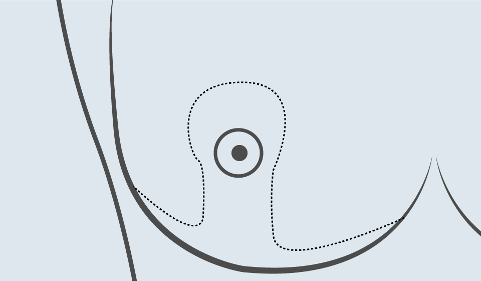 Técnicas de Cirugía Oncoplástica